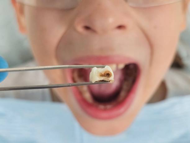 Best Emergency Treatment for Dental Infections or Abscesses in Sterling City, TX